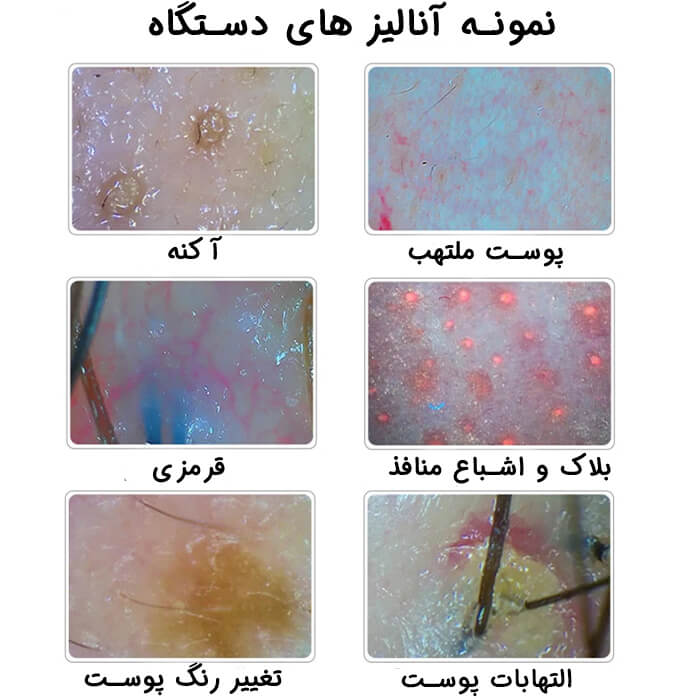 نمونه انالیز با دستگاه آنالیز پوست و مو لیز 15 اینچ UV دار