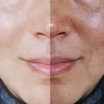 مرطوب كننده ضد لک ( لک ملاسما) تنورا 100 میل - تصویر 2