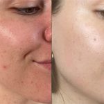 اسید لایه بردار حرفه ای رتینوئید 5 درصد تنورا 50 میل - Image 2