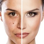 اسید لایه بردار آلفا پيل تنورا 50 میل - تصویر 2