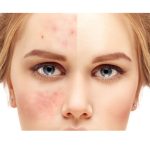 اسید لایه بردار آسترا پيل تنورا 50 میل - تصویر 2