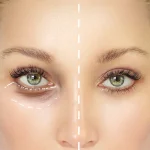 کمپلکس لیفتینگ دور چشم دکتر بلتر 15 میل - تصویر 2