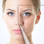 آمپول ضد جوش دکتر بلتر - تصویر 2