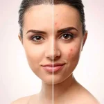 قلم ضد جوش دو کاره (ضد جوش و کانسیلر) دکتر بلتر 6 میل - تصویر 2