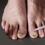 ضد قارچ ناخن پا تنورا 20 میل - Image 2